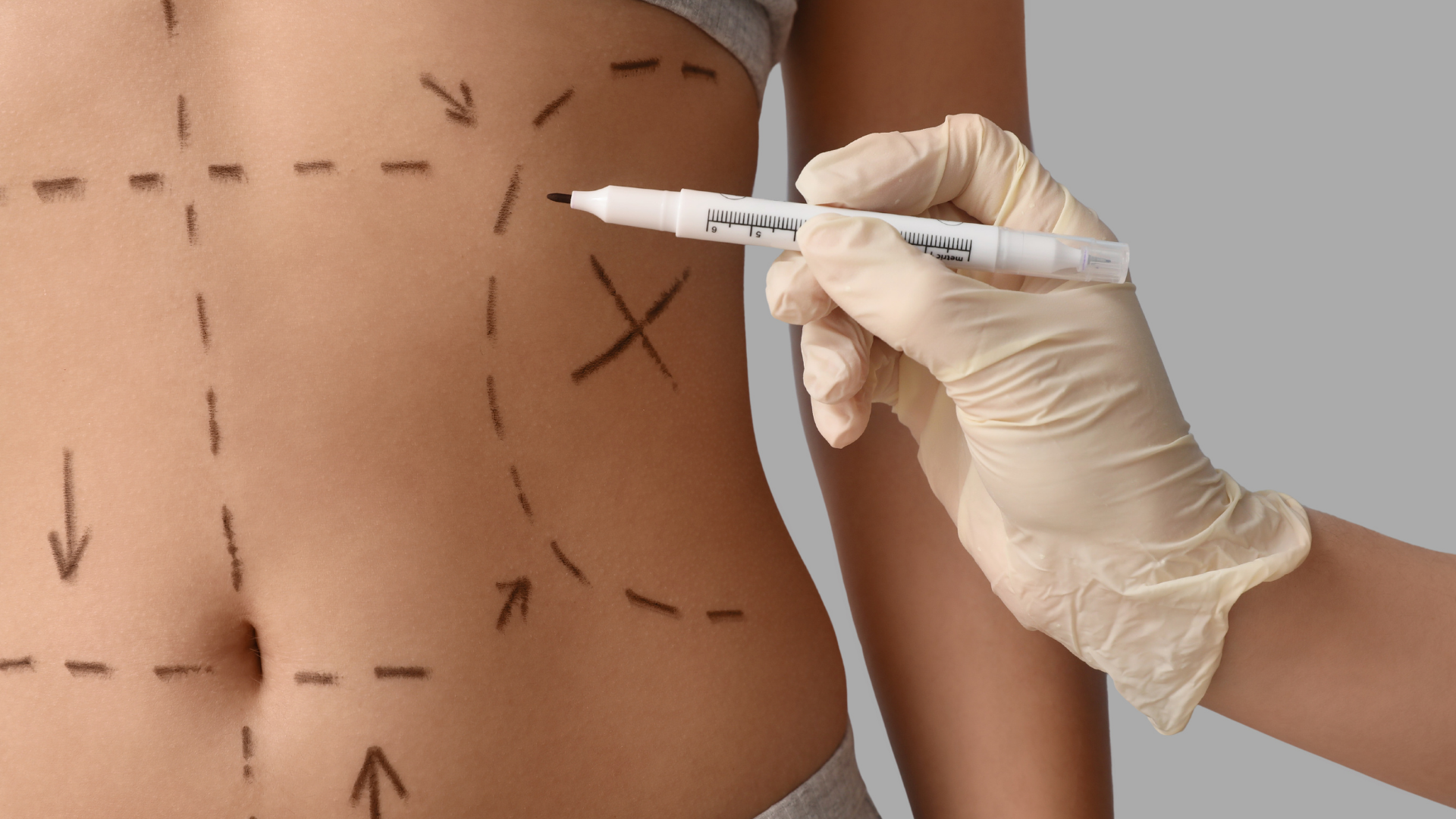Lipoaspiração