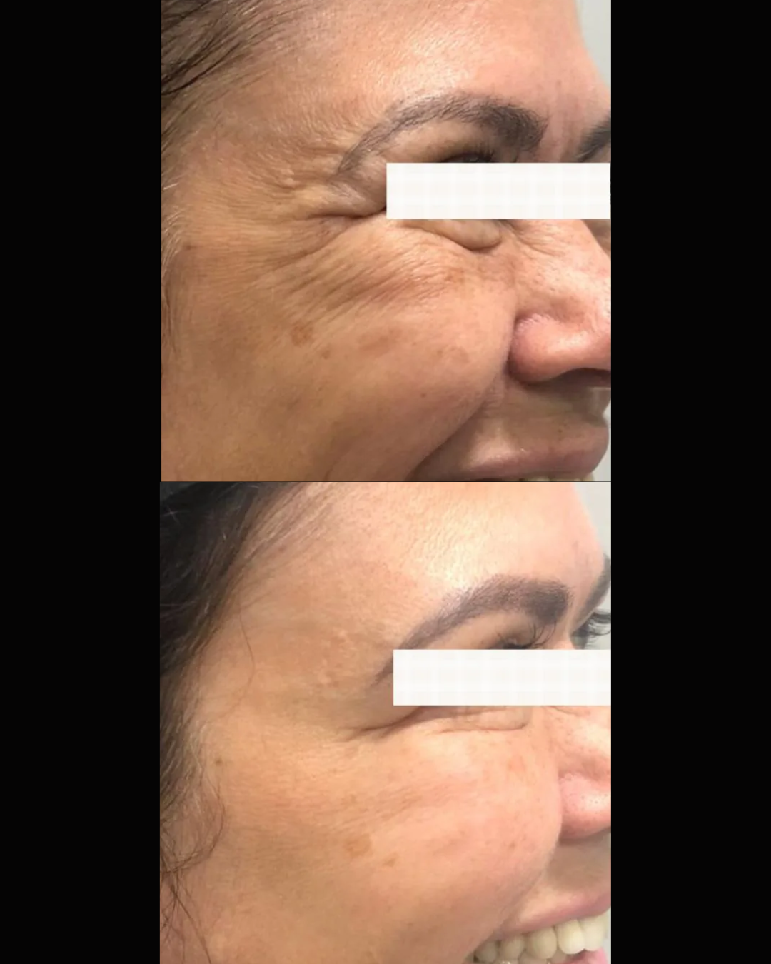 Resultado Botox