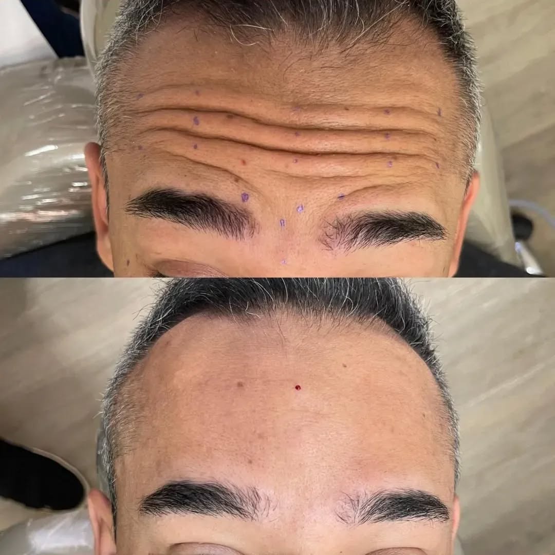 Resultado Botox Testa