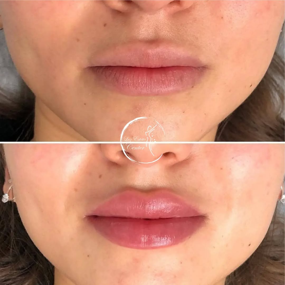Resultado Preenchimento Labial