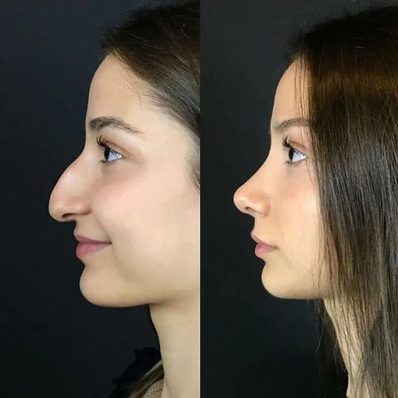 Resultado Rinoplastia